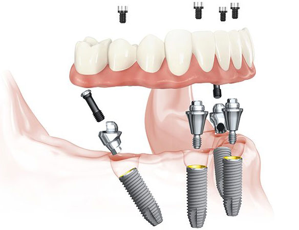 dental implant