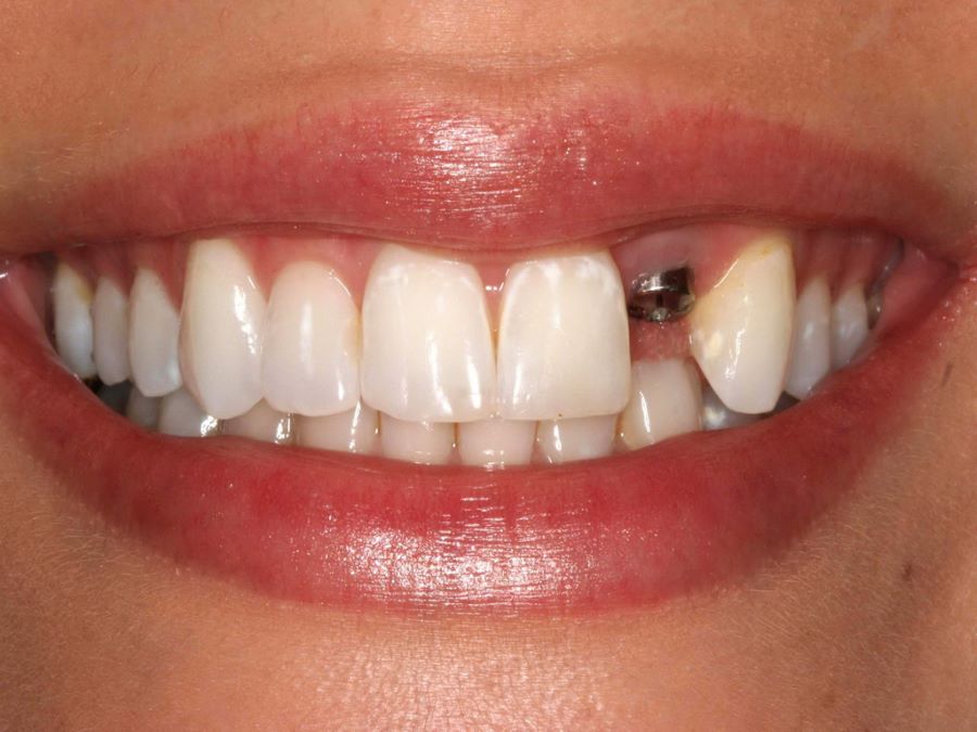 candidate-of-implant