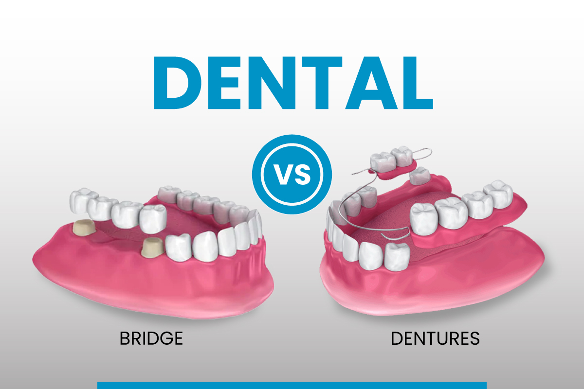 Dentures vs bridge