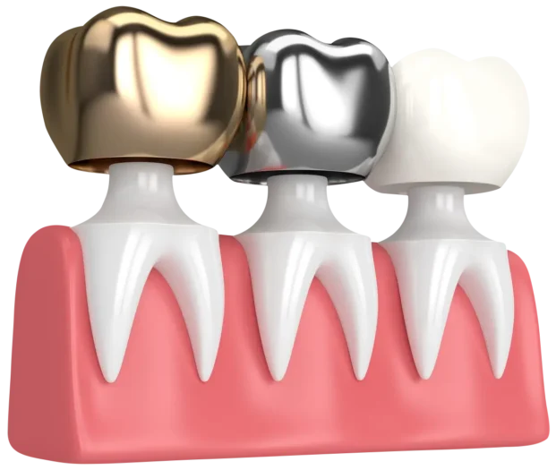 Types of Crown