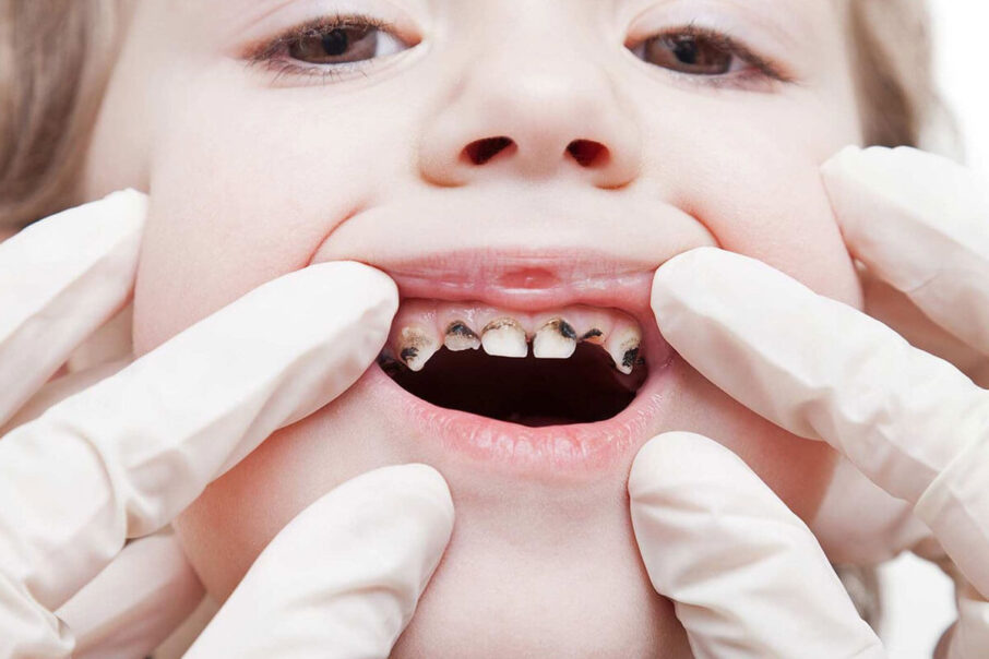 Tooth Decay