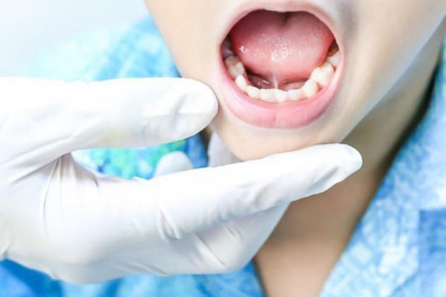 Frenectomy