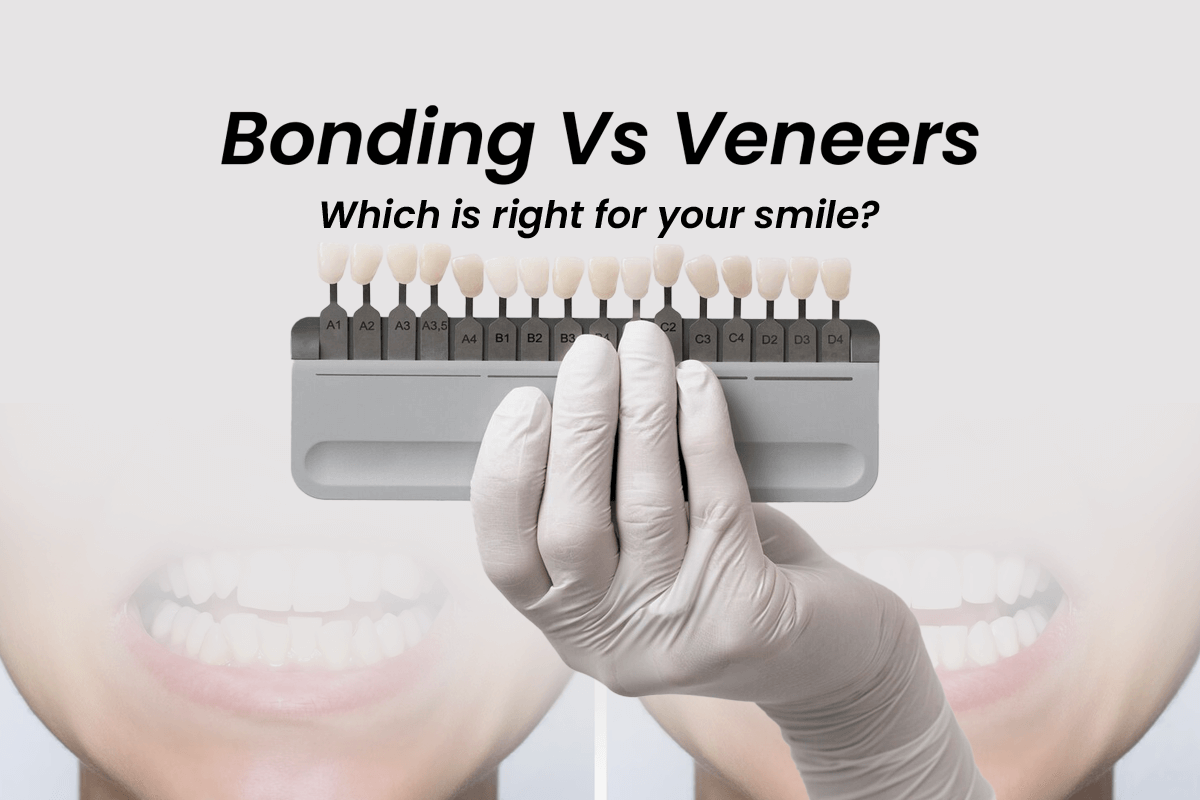 Veneers