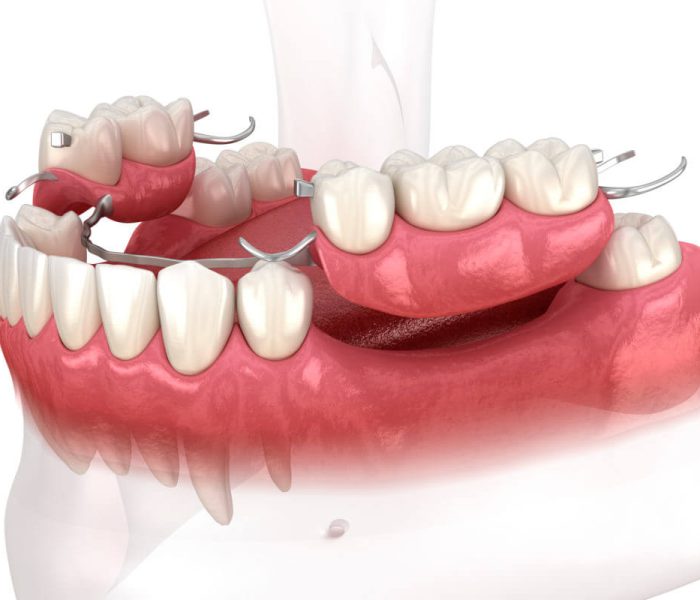 Cast-Metal-Partial-Dentures-O