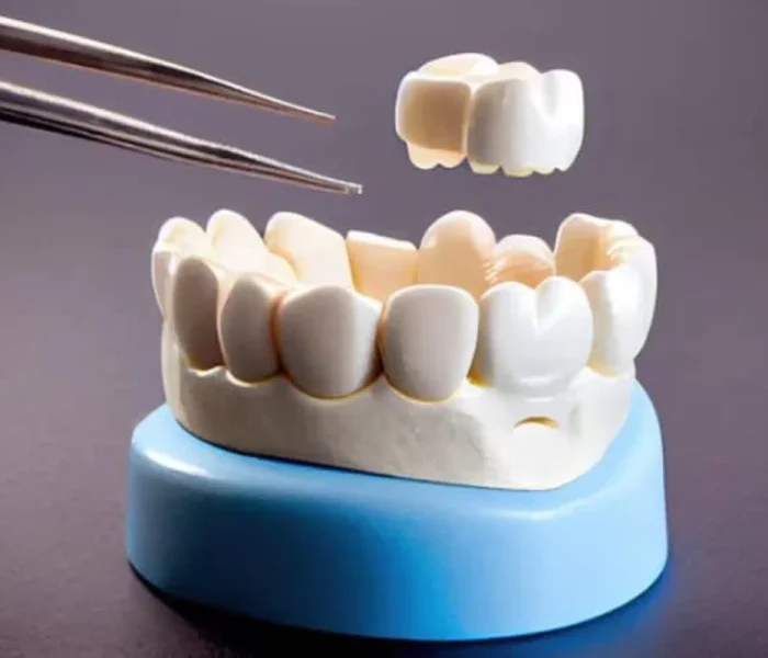 Dental Crowns