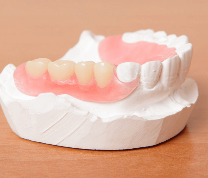 Flexible-Partial-Dentures-O