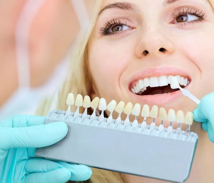 Porcelain Veneers