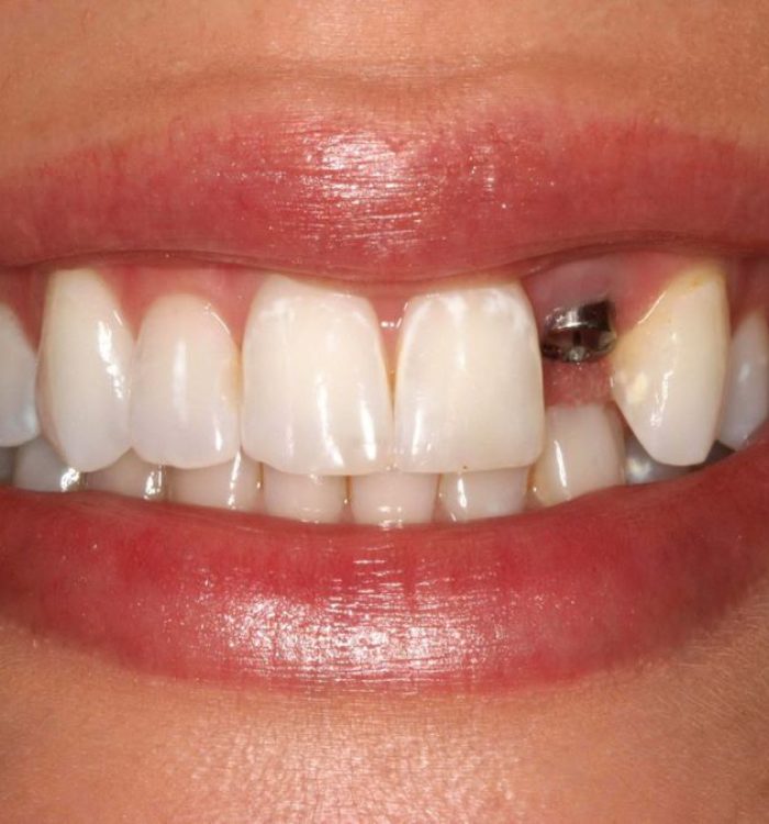 candidate-of-implant candidate-of-implant