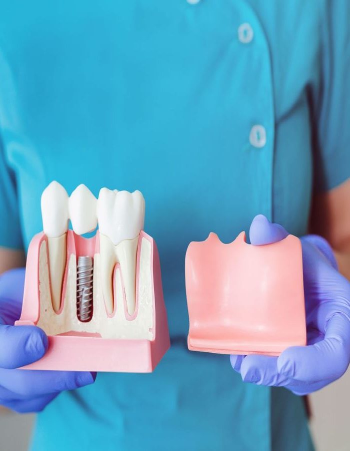 implant implant